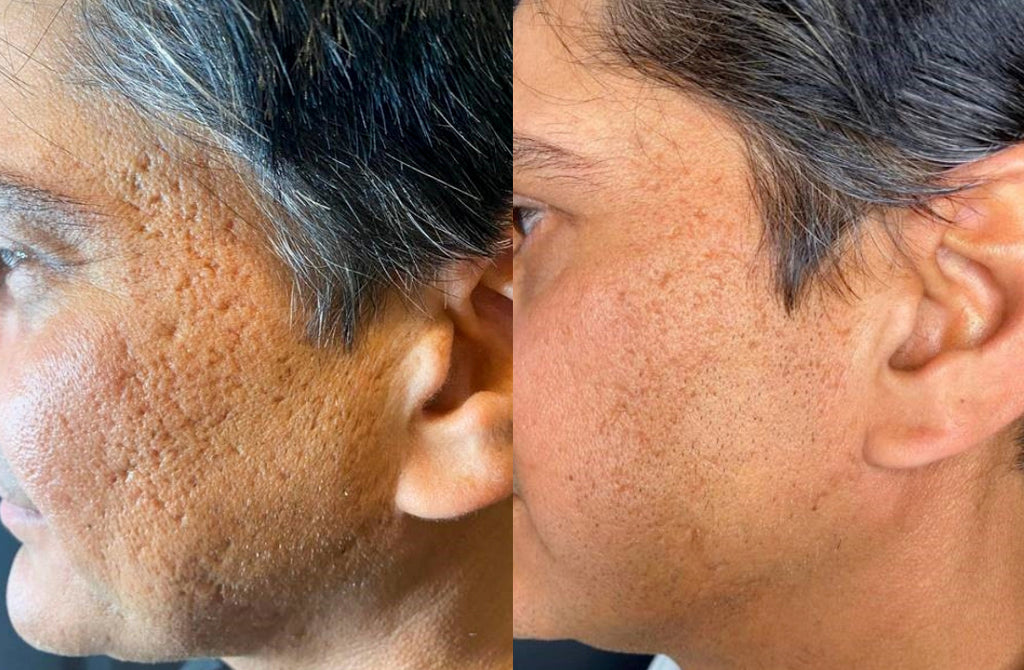 Before and After RF Microneedling Treatment to Acne Scarring