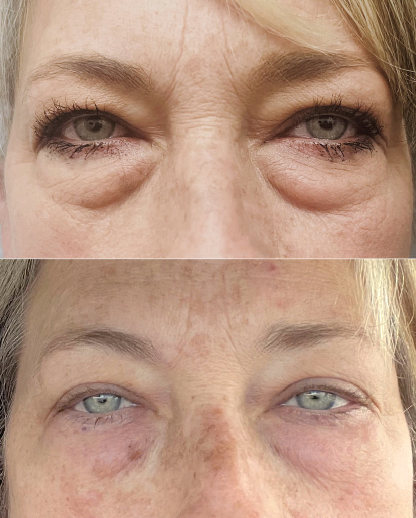 Before and After RF Microneedling Treatment to Under Eye Bags