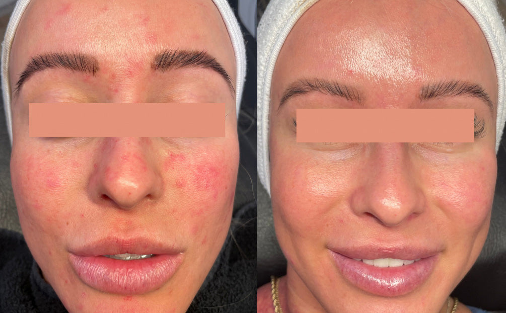 IPL Photofacial Before and After of Red Skin Issues