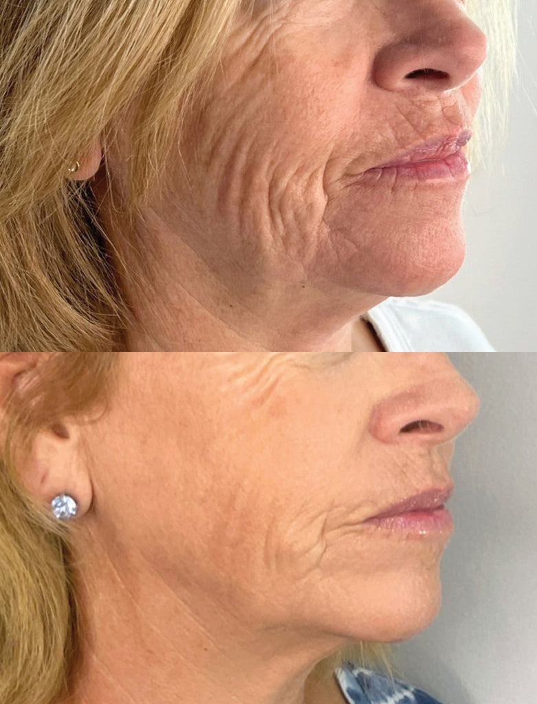 Before and After RF Microneedling Treatment to Cheeks