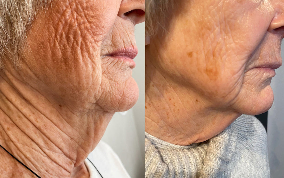 Before and After RF Microneedling Treatment to Face and Neck