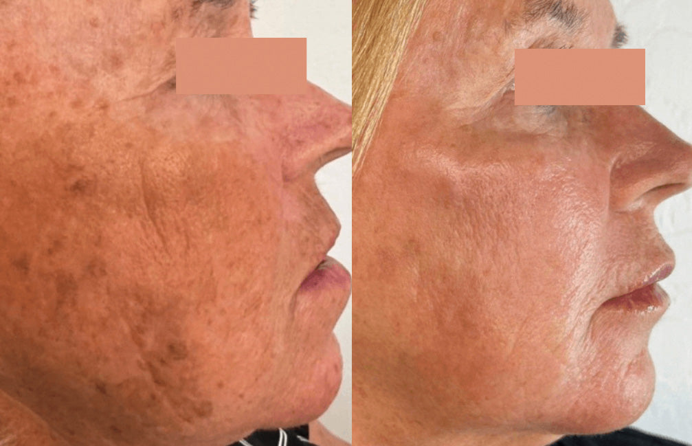 IPL Photofacial Before and After of Age Spots and Sun Spots