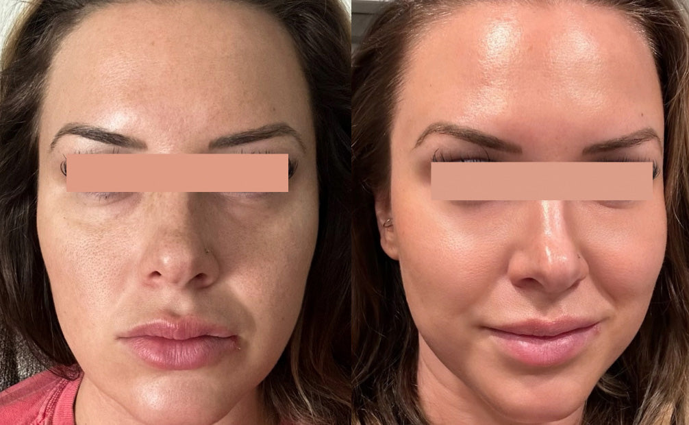 IPL Photofacial Before and After