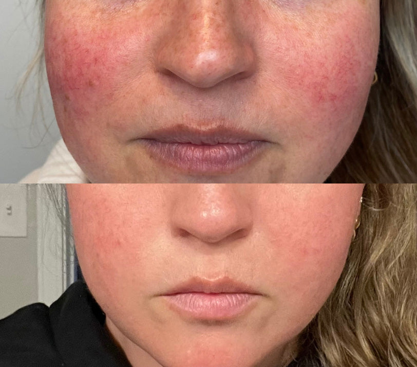 IPL Photofacial Before and After on Rosacea on Cheeks