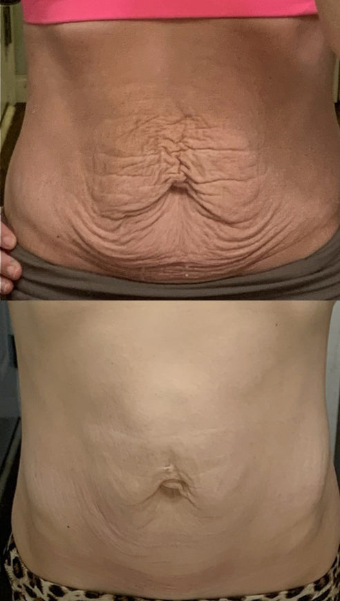 Before and After RF Microneedling Treatment to Stomach