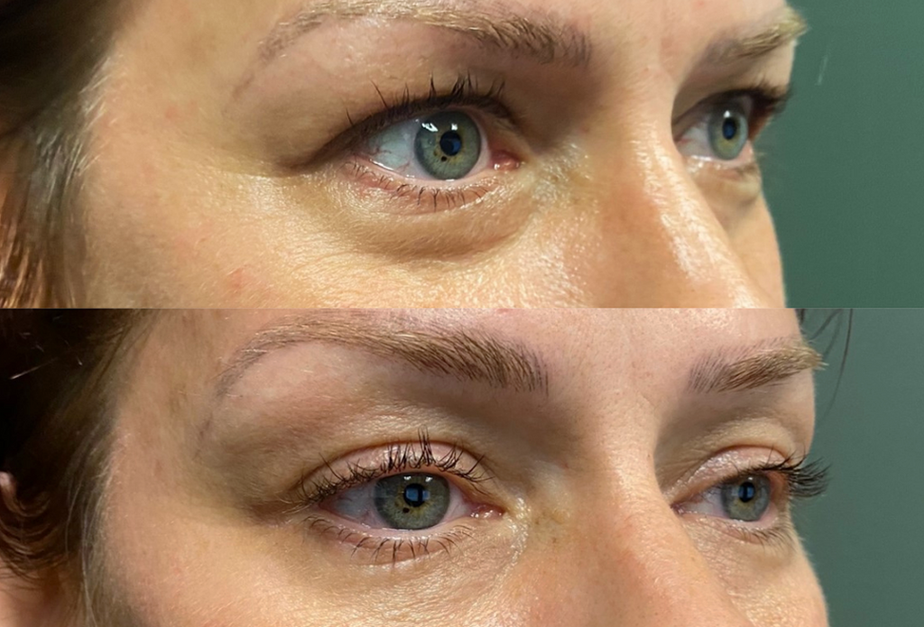 Subnovii Plasma Pen Skin Tightening Before and After