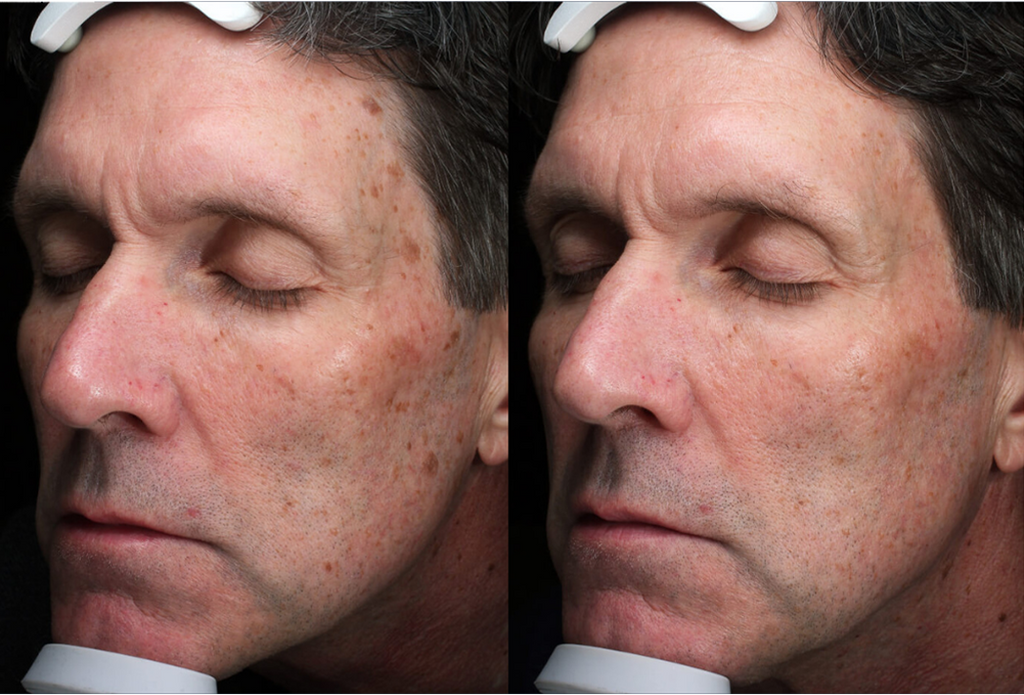 Subnovii Plasma Pen Skin Tightening Before and After