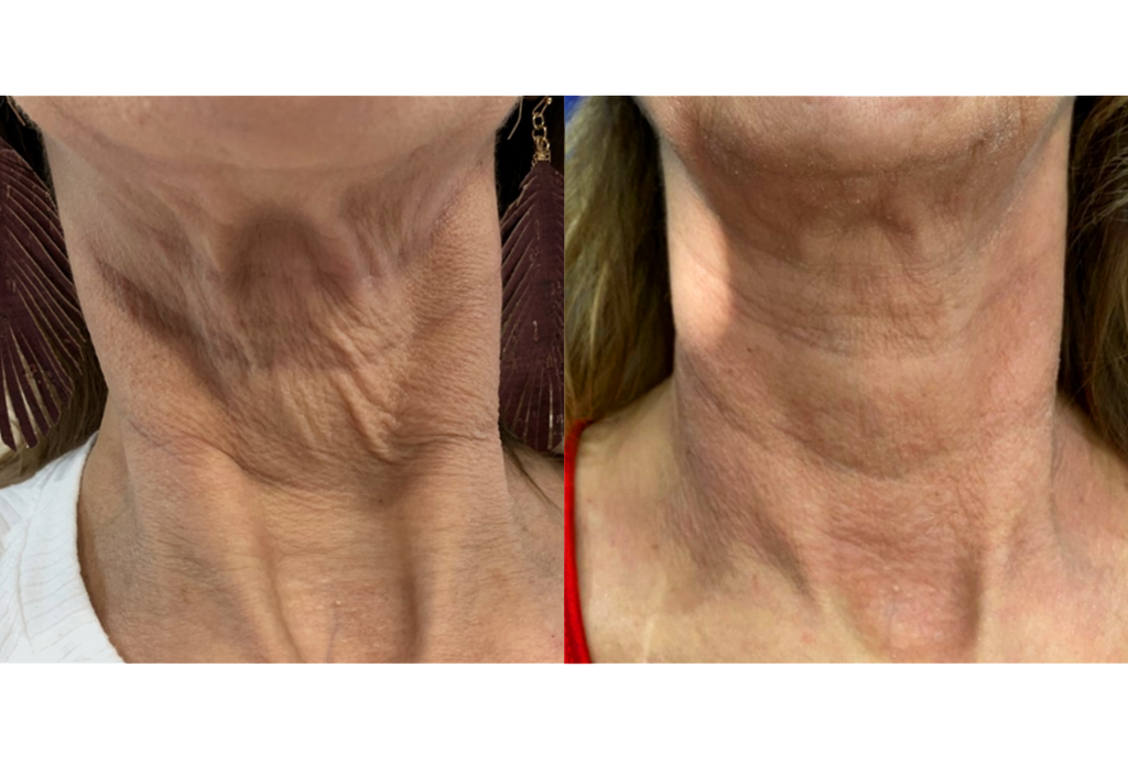 Subnovii Plasma Pen Skin Tightening Before and After