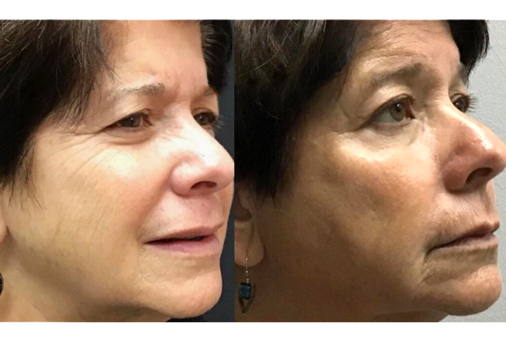 Subnovii Plasma Pen Skin Tightening Before and After