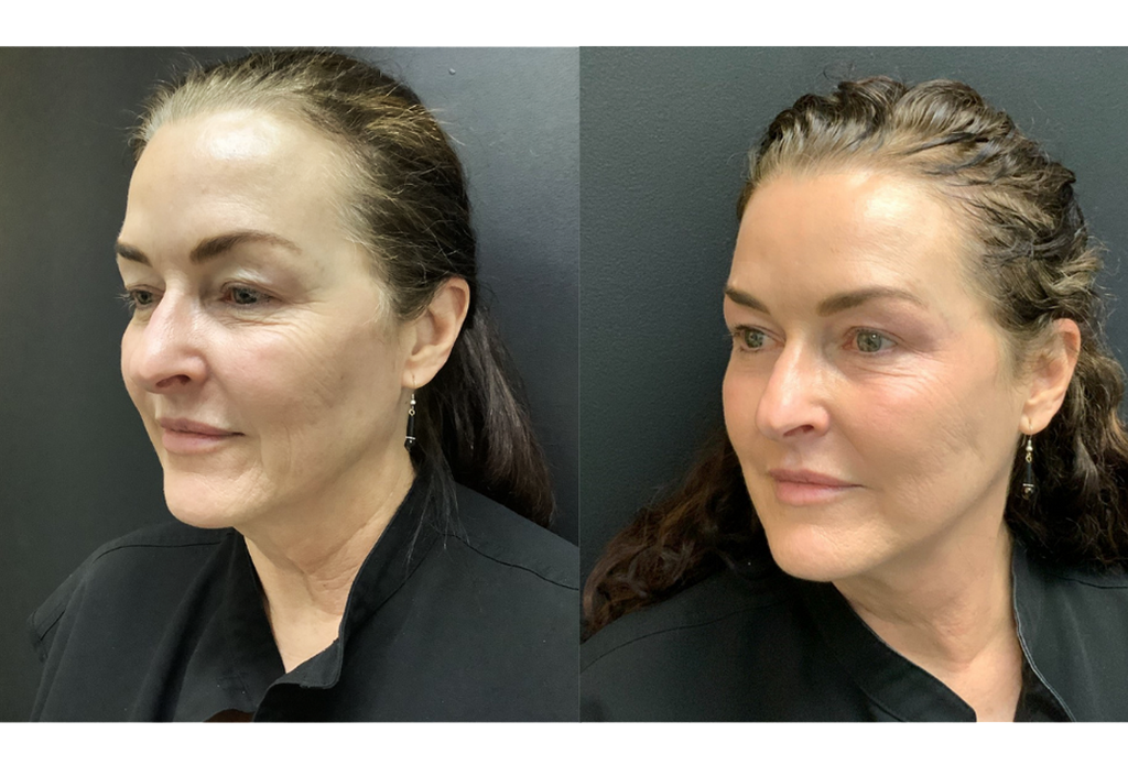 Subnovii Plasma Pen Skin Tightening Before and After