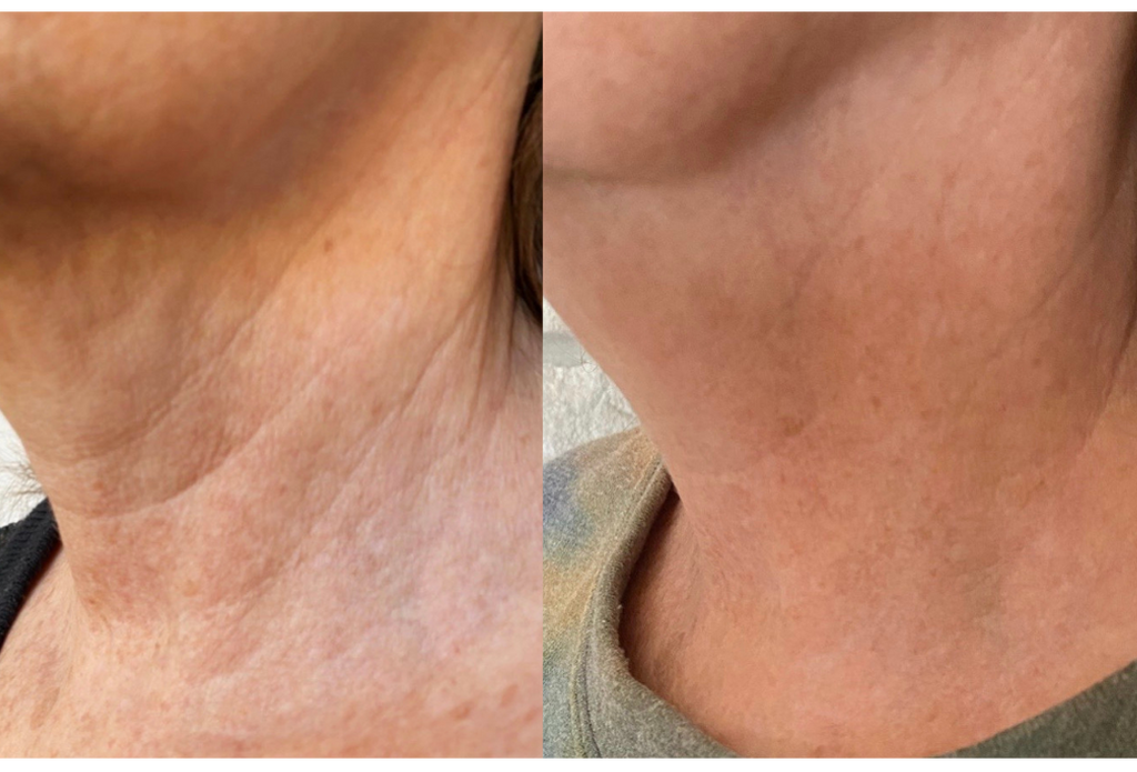 Subnovii Plasma Pen Skin Tightening Before and After