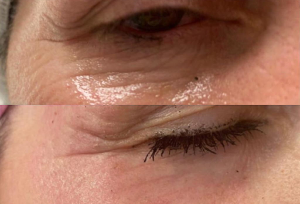 Subnovii Plasma Pen Skin Tightening Before and After