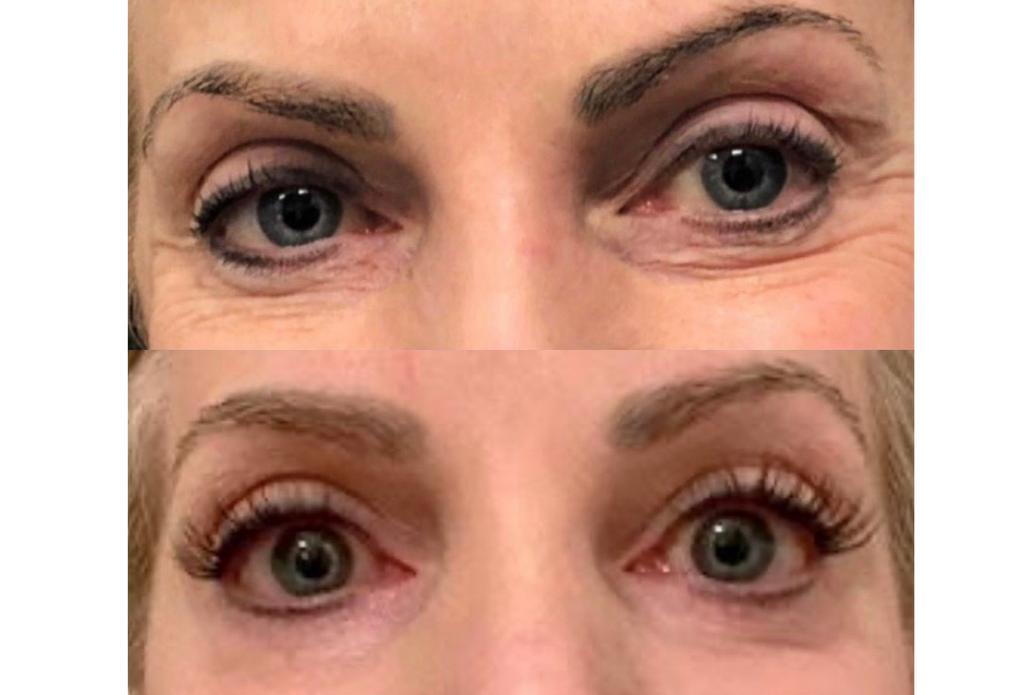 Subnovii Plasma Pen Skin Tightening Before and After