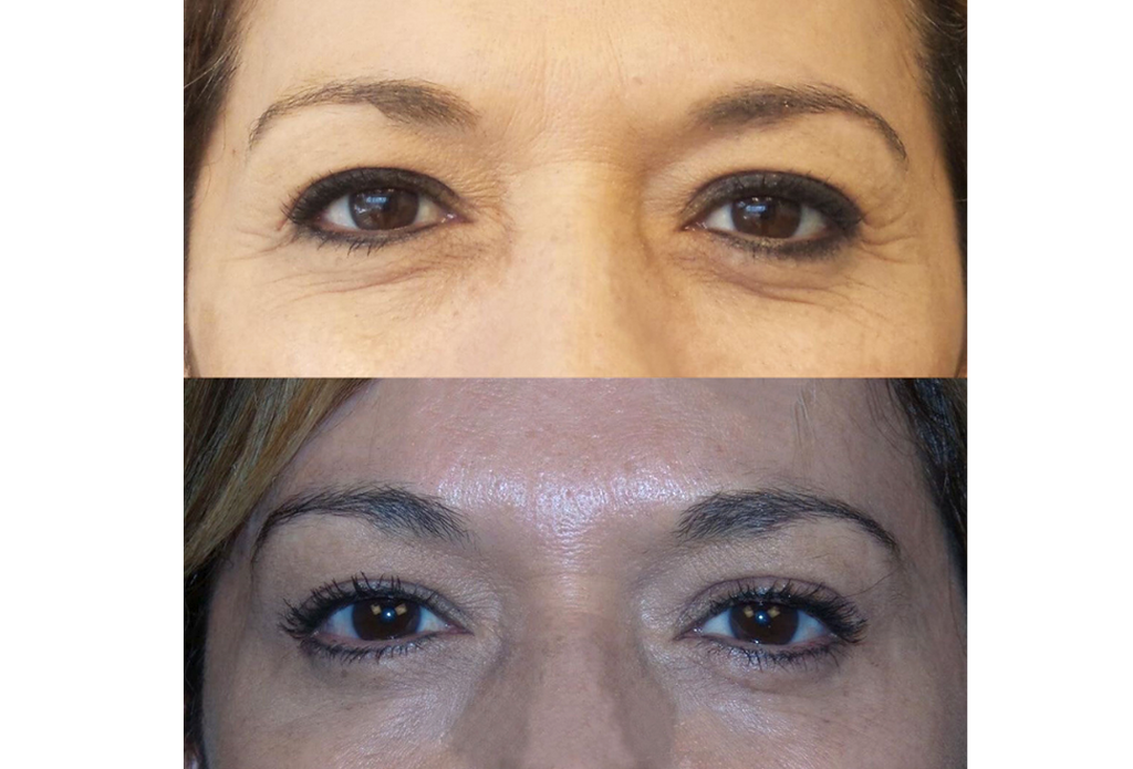Subnovii Plasma Pen Skin Tightening Before and After