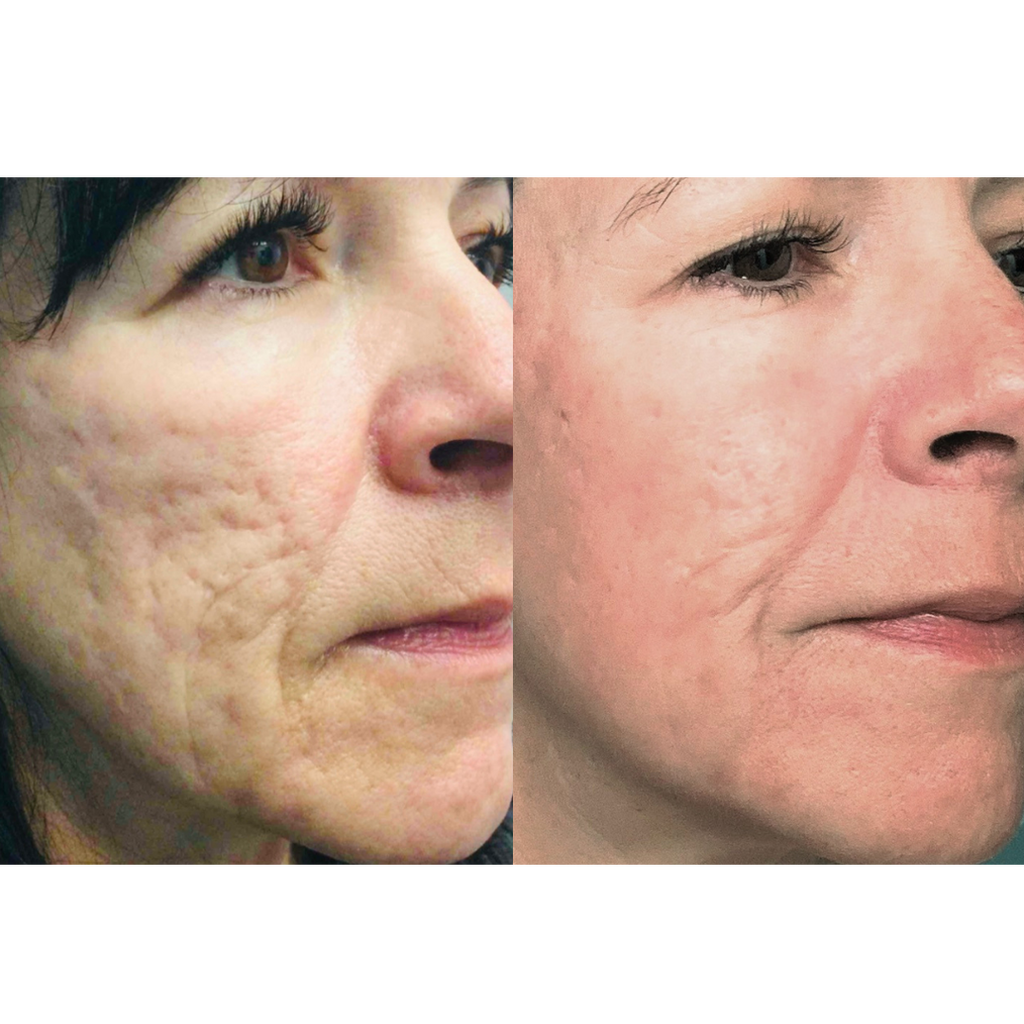 Tetra CoolPeel® CO2 Laser Skin Resurfacing Before and After