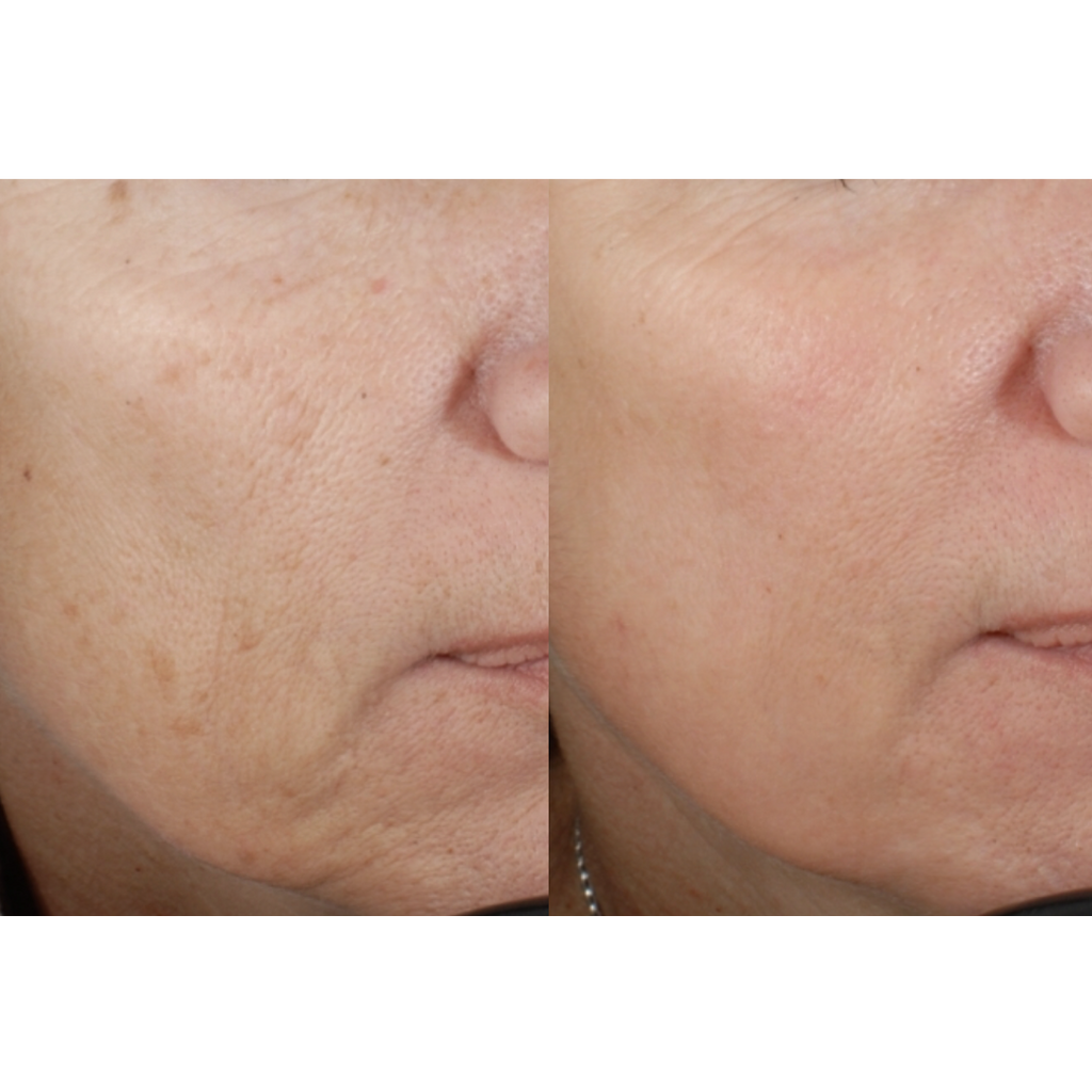 Tetra CoolPeel® CO2 Laser Skin Resurfacing Before and After
