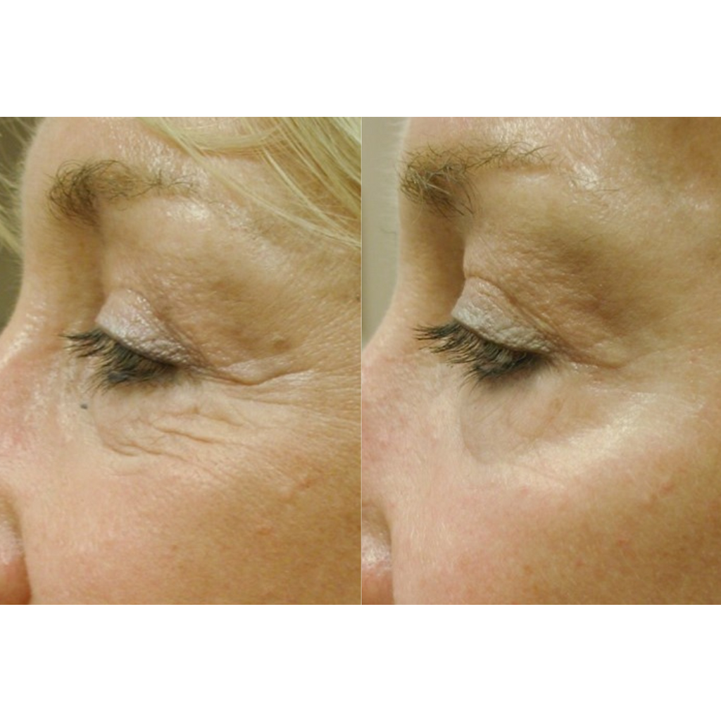 Tetra CoolPeel® CO2 Laser Skin Resurfacing Before and After