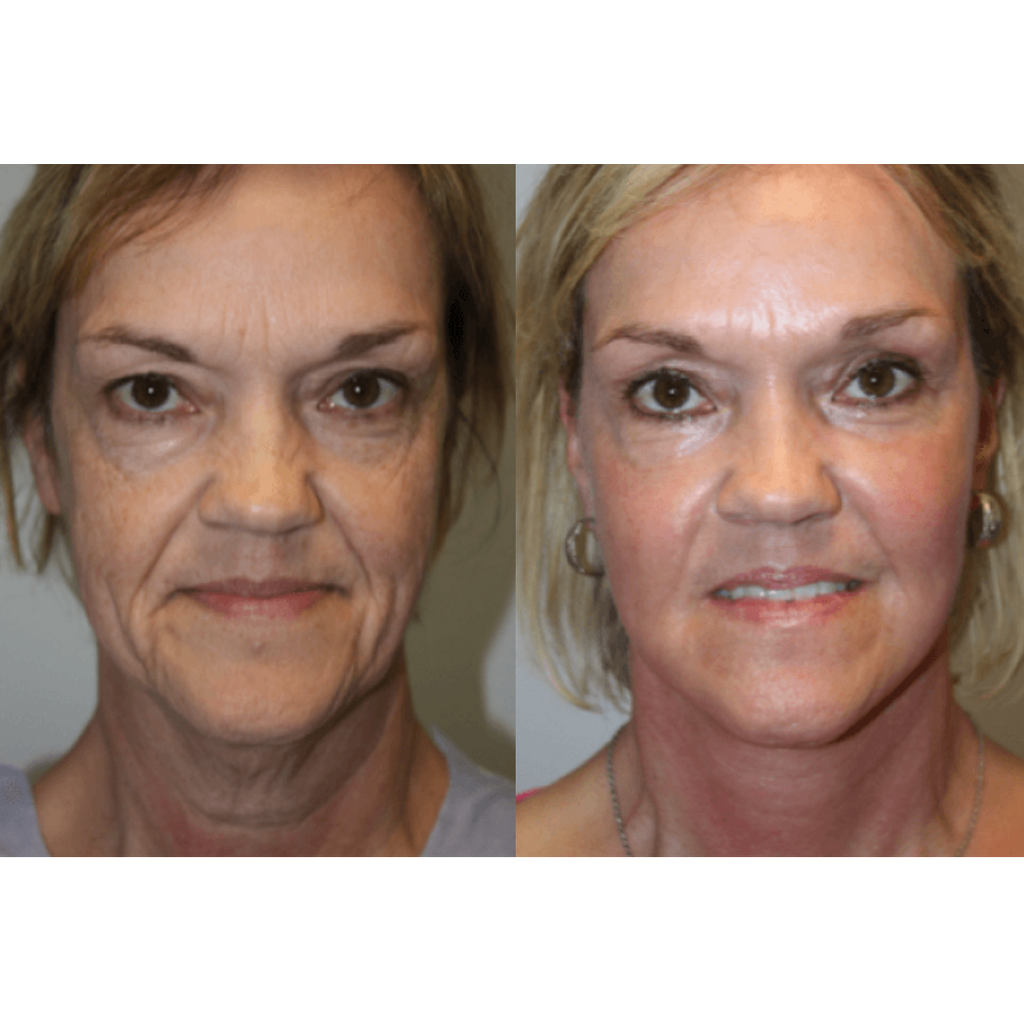 Tetra CoolPeel® CO2 Laser Skin Resurfacing Before and After