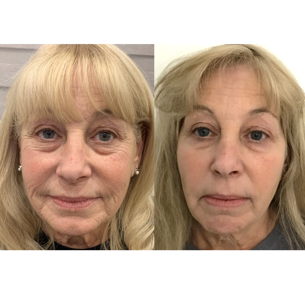 Tetra CoolPeel® CO2 Laser Skin Resurfacing Before and After