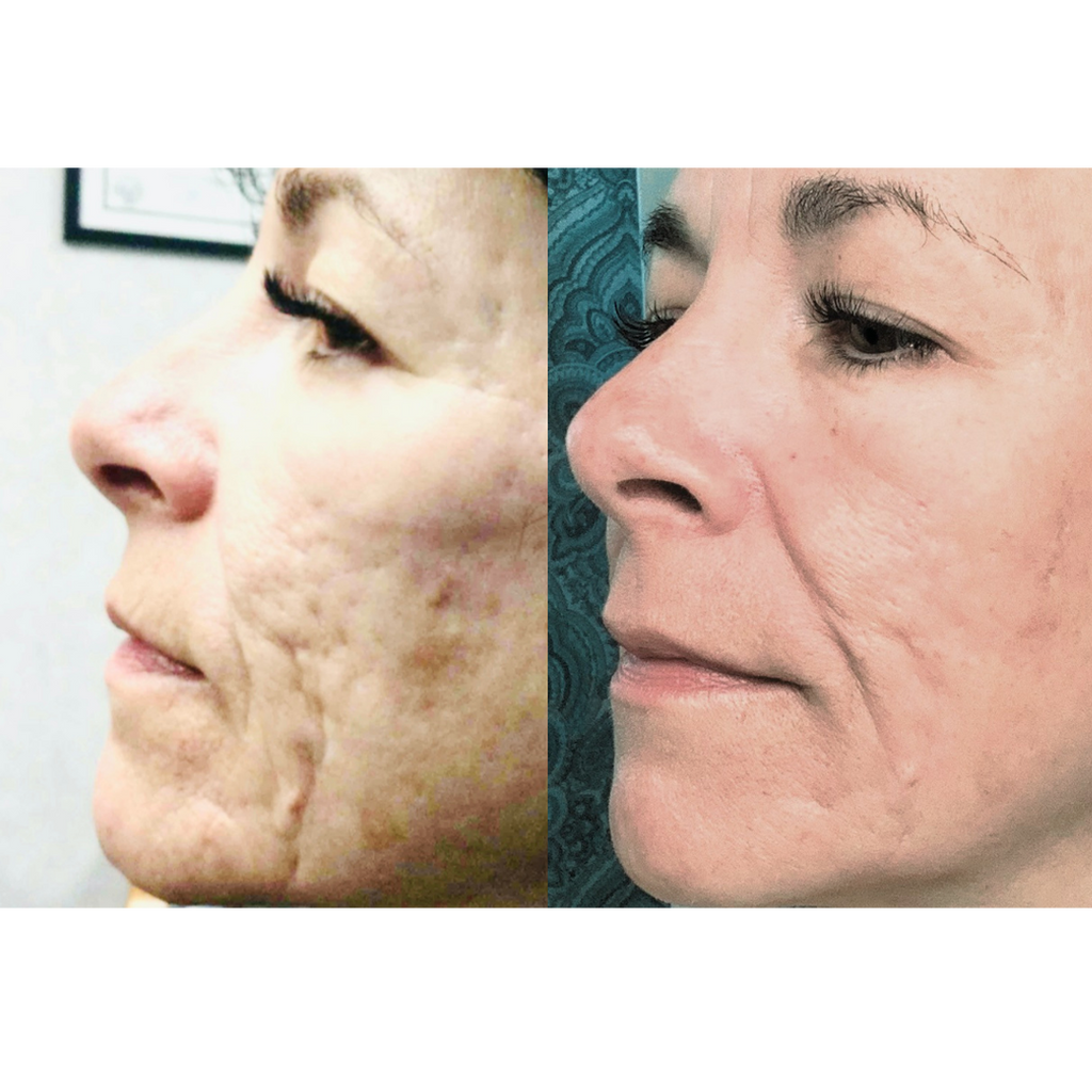 Tetra CoolPeel® CO2 Laser Skin Resurfacing Before and After