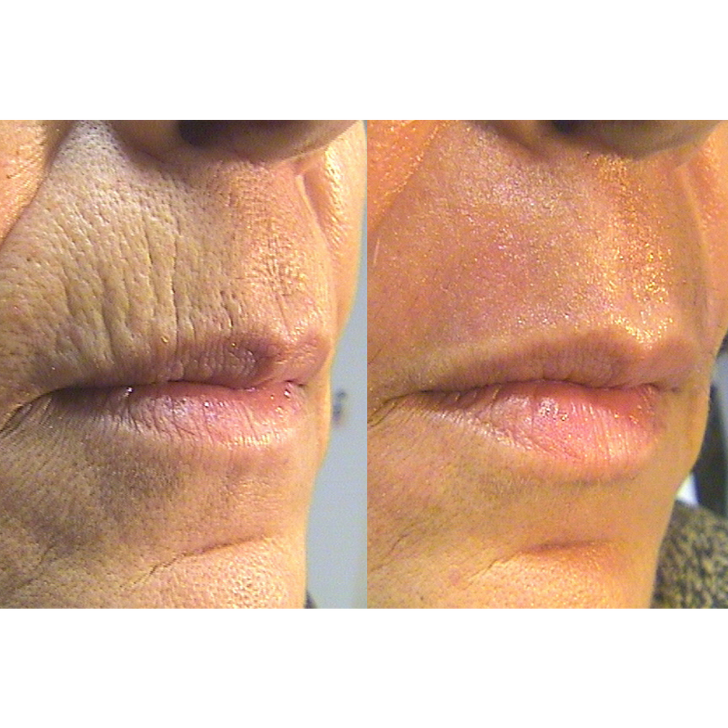 Tetra CoolPeel® CO2 Laser Skin Resurfacing Before and After