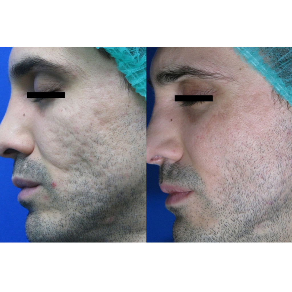Tetra CoolPeel® CO2 Laser Skin Resurfacing Before and After