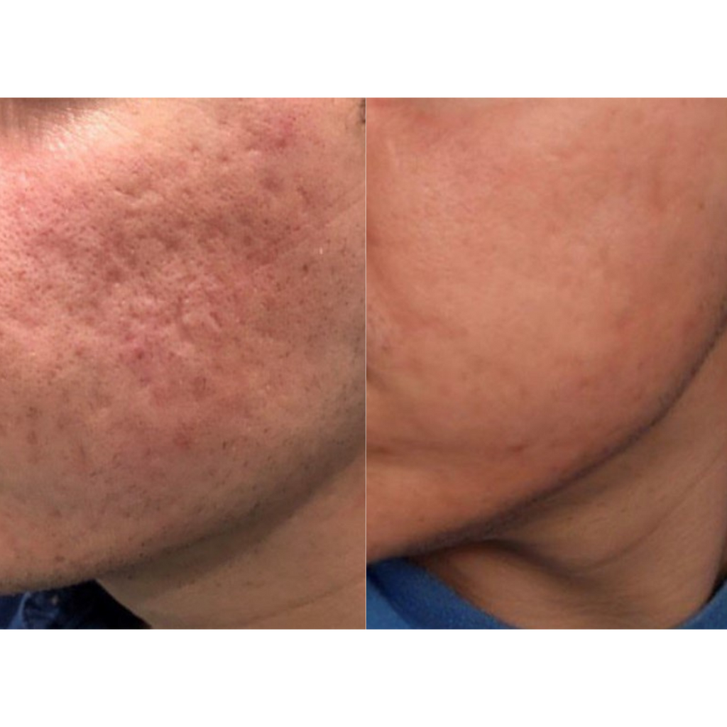 Tetra CoolPeel® CO2 Laser Skin Resurfacing Before and After