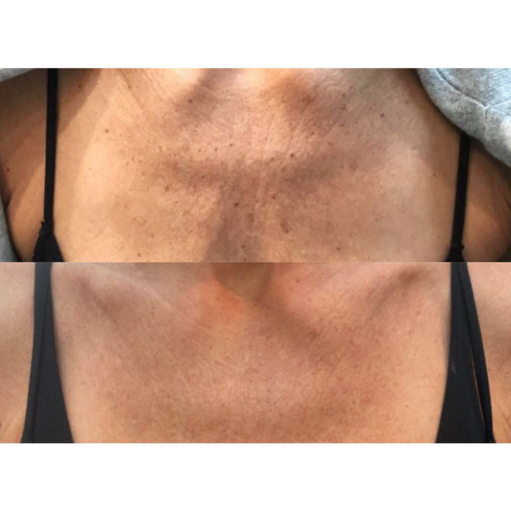 Tetra CoolPeel® CO2 Laser Skin Resurfacing Before and After
