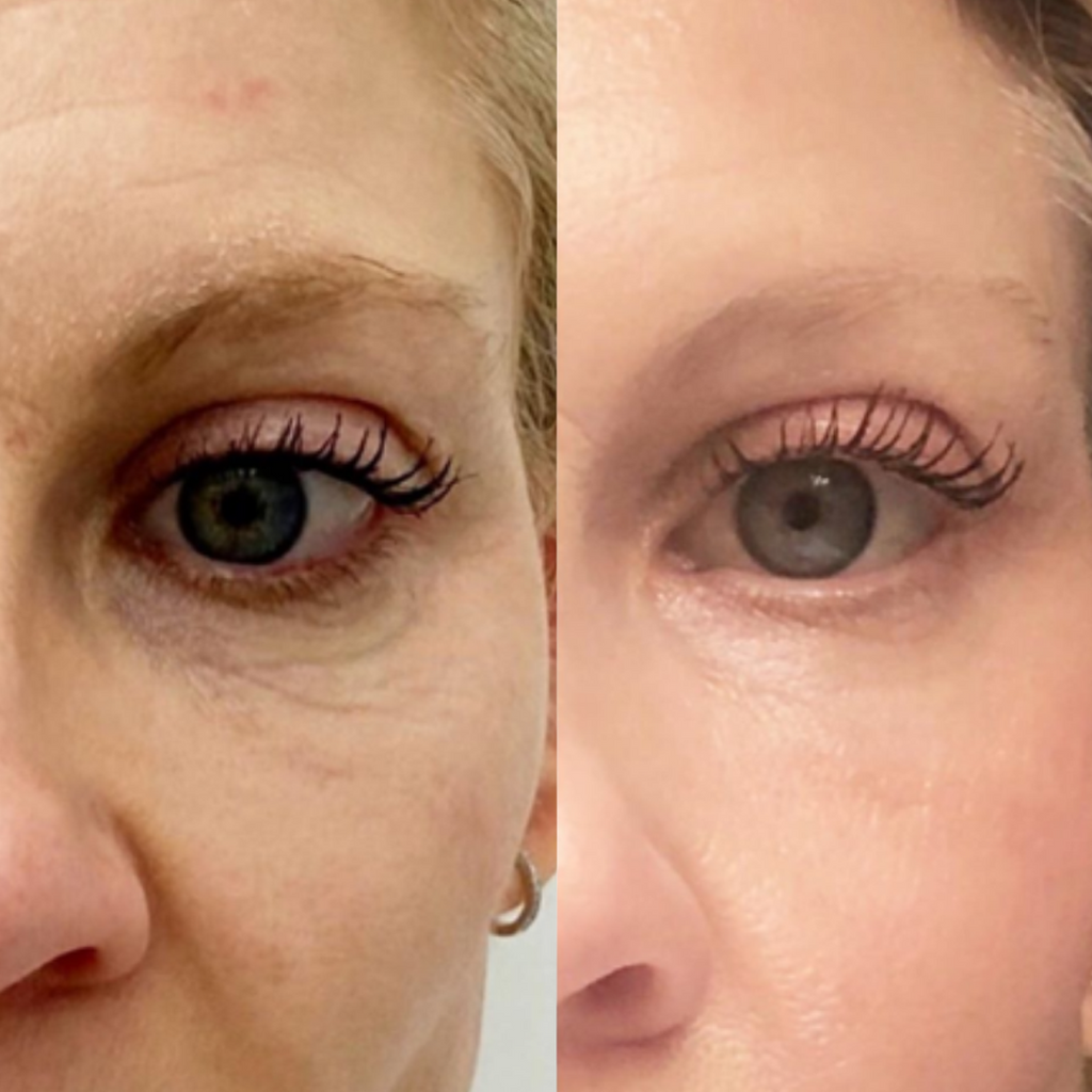Tetra CoolPeel® CO2 Laser Skin Resurfacing Before and After