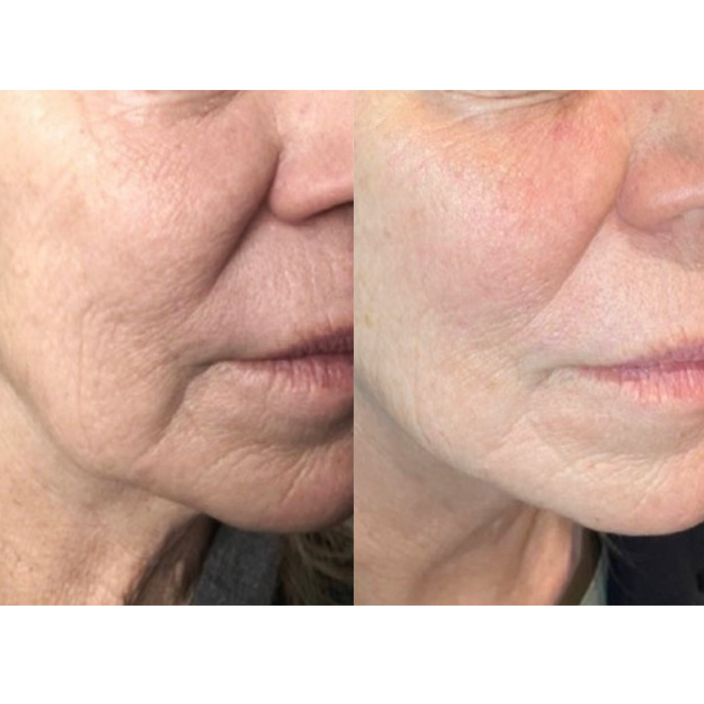 Tetra CoolPeel® CO2 Laser Skin Resurfacing Before and After