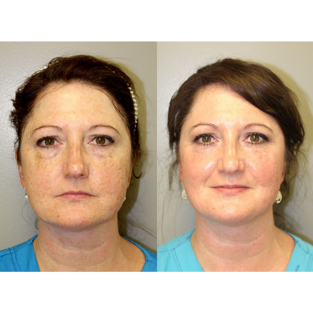 Tetra CoolPeel® CO2 Laser Skin Resurfacing Before and After