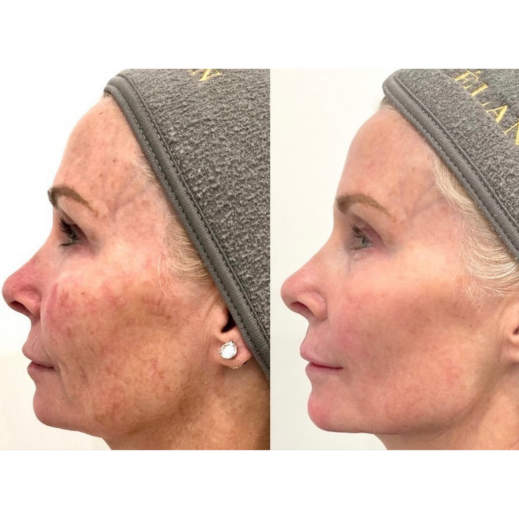 Tetra CoolPeel® CO2 Laser Skin Resurfacing Before and After