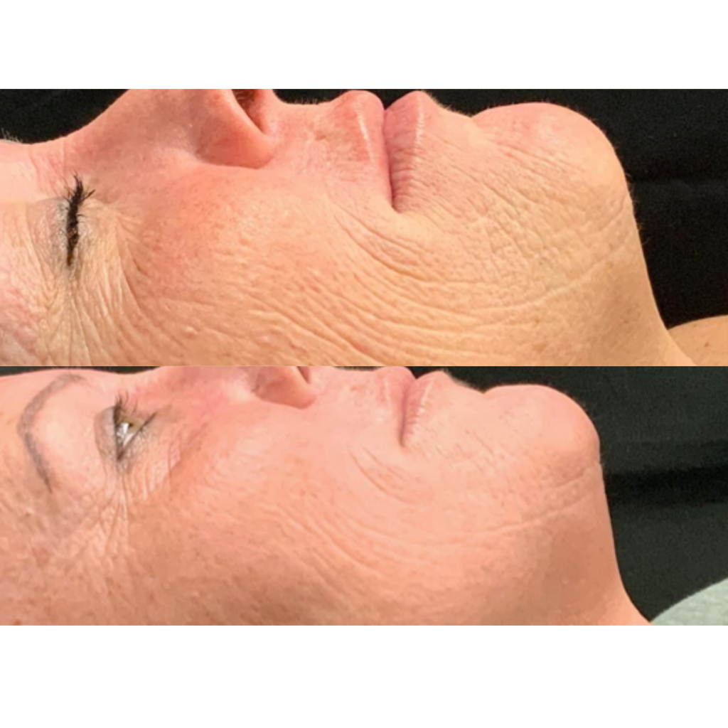 Tetra CoolPeel® CO2 Laser Skin Resurfacing Before and After
