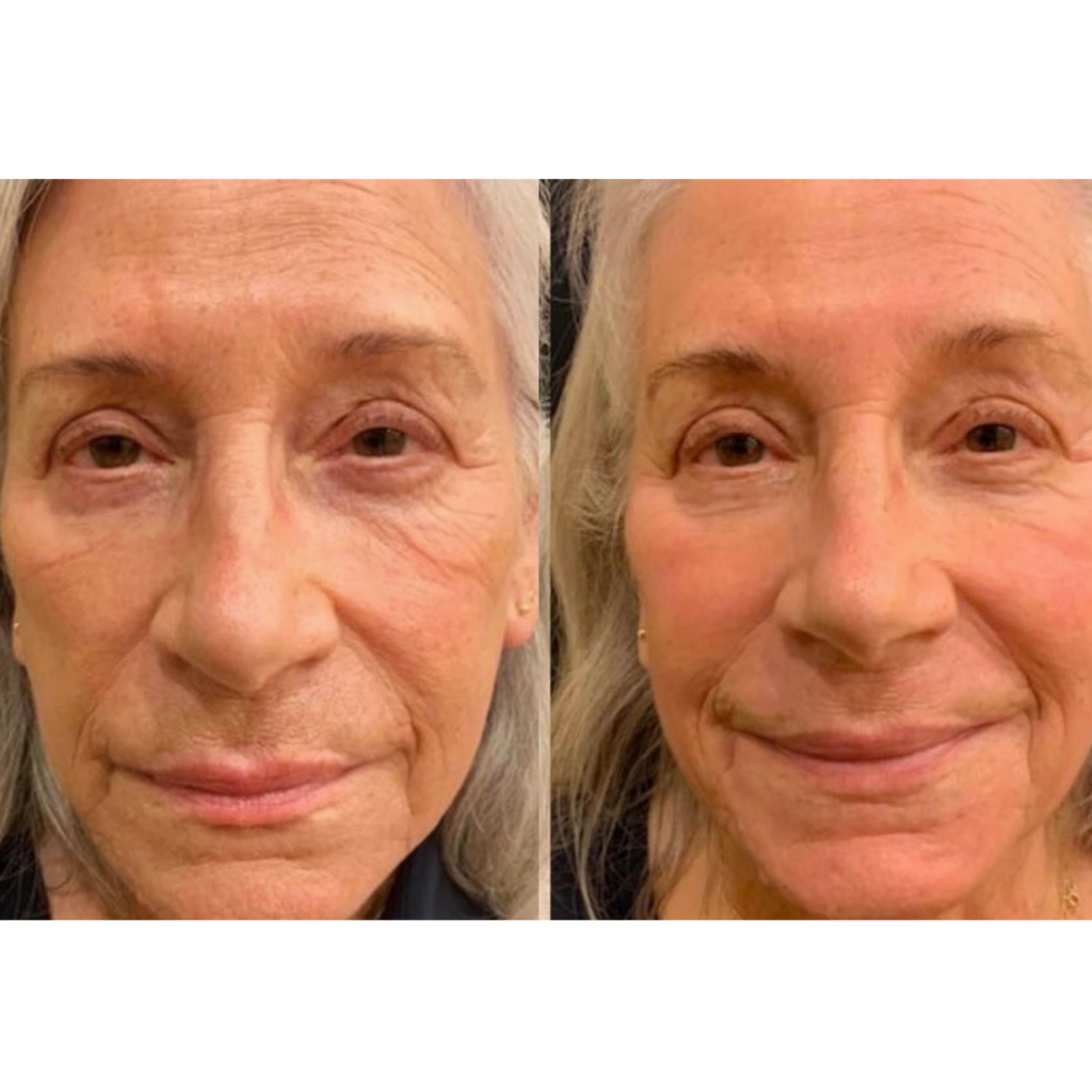 Tetra CoolPeel® CO2 Laser Skin Resurfacing Before and After