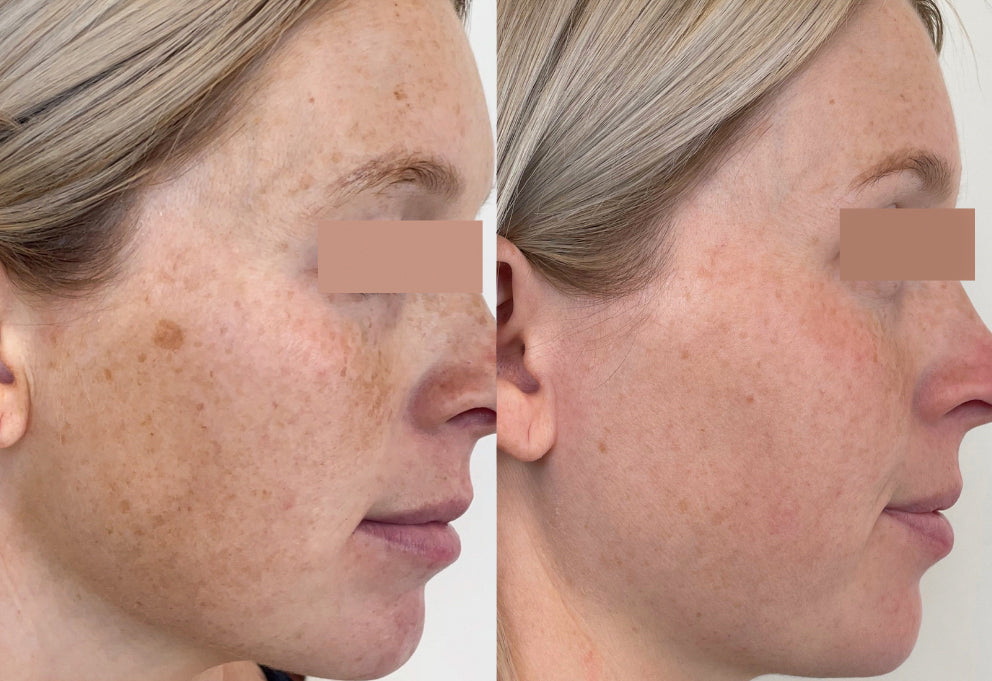 Before and After RF Microneedling Treatment to Skin Pigmentation/Discoloration